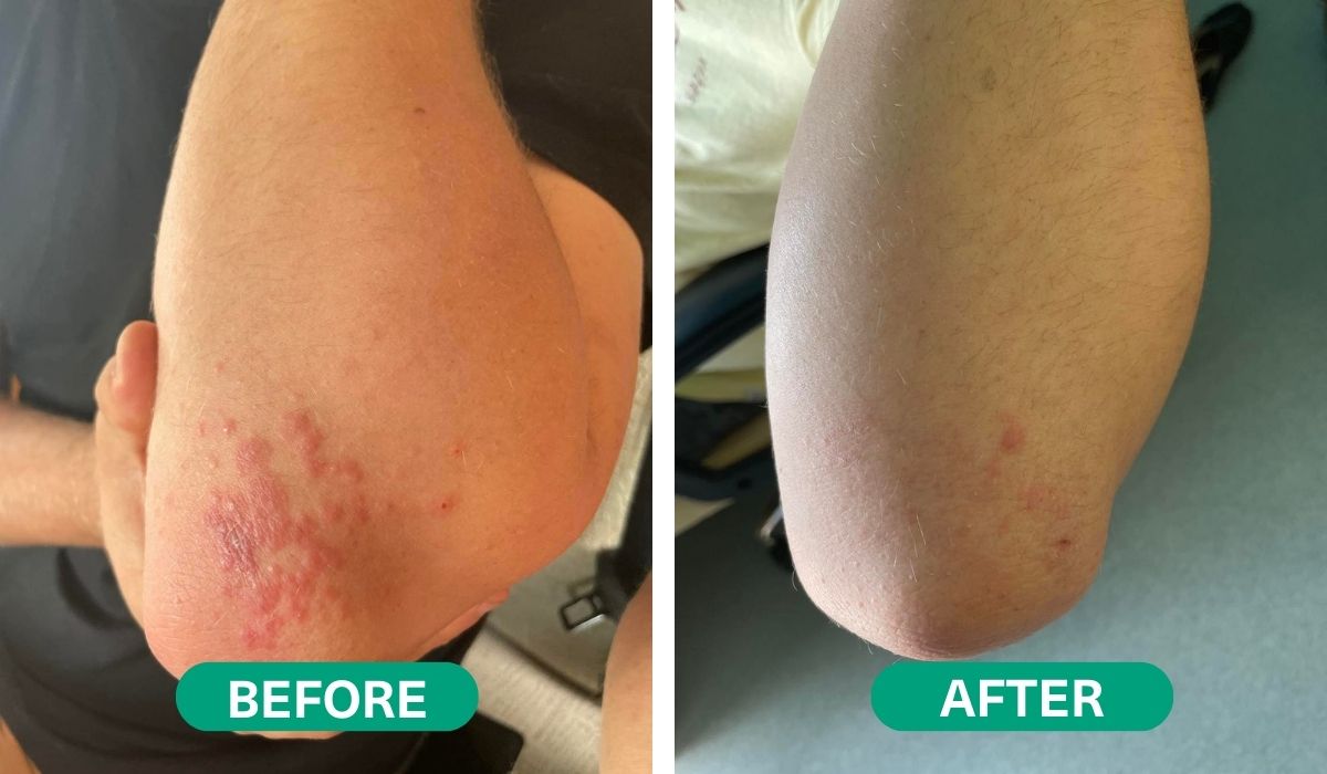 terapinis CBD odos balzamas ramina egzemą, psoriazę, atopinį dermatitą Hemptouch